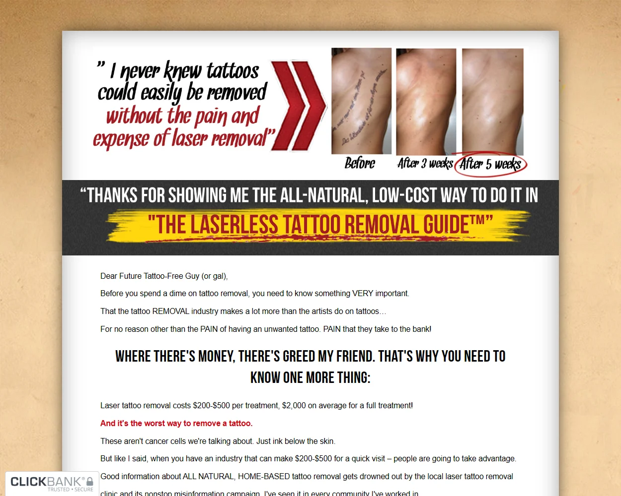 The Laserless Tattoo Removal features